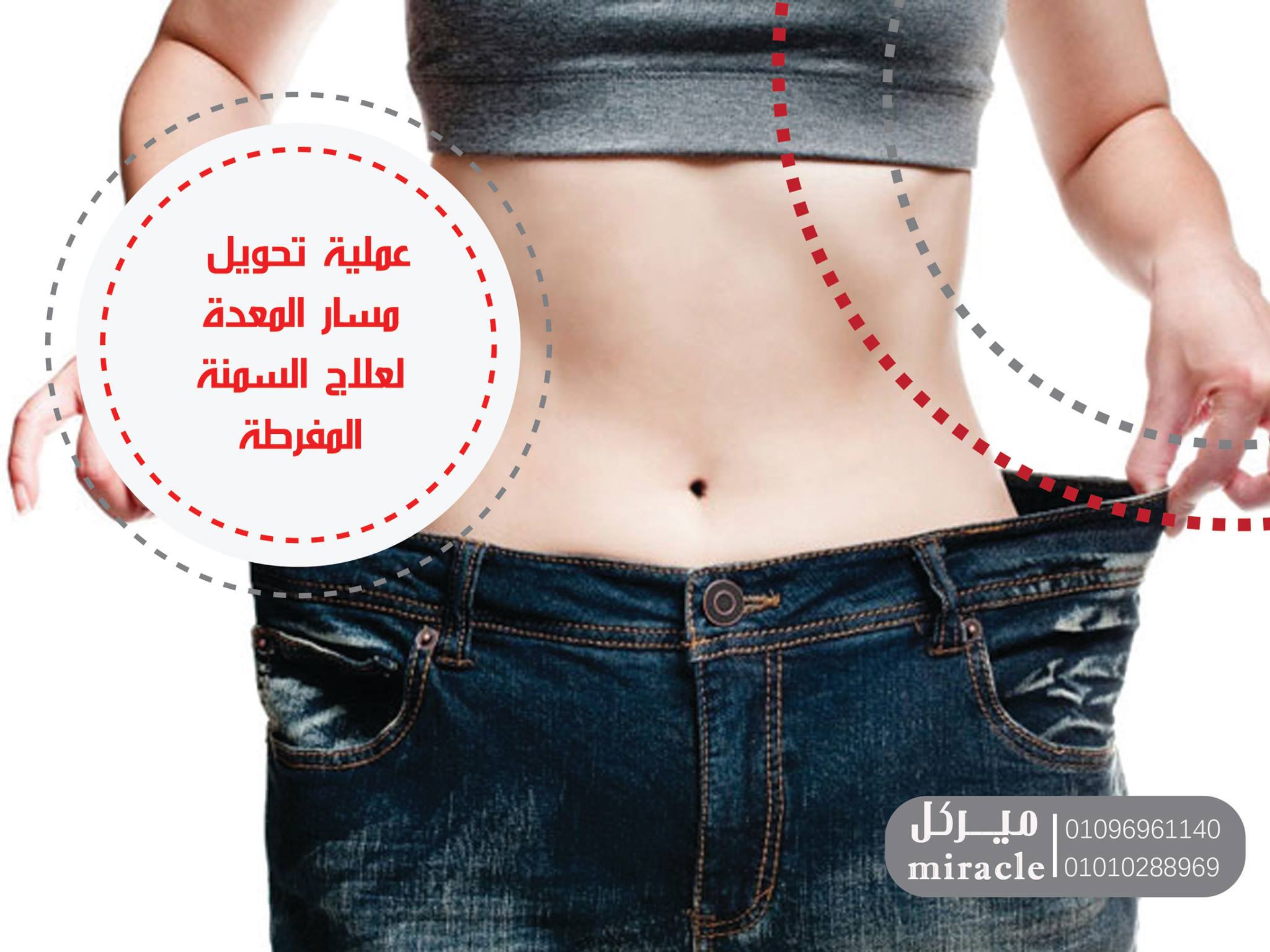 تجربتي مع تحويل مسار المعدة