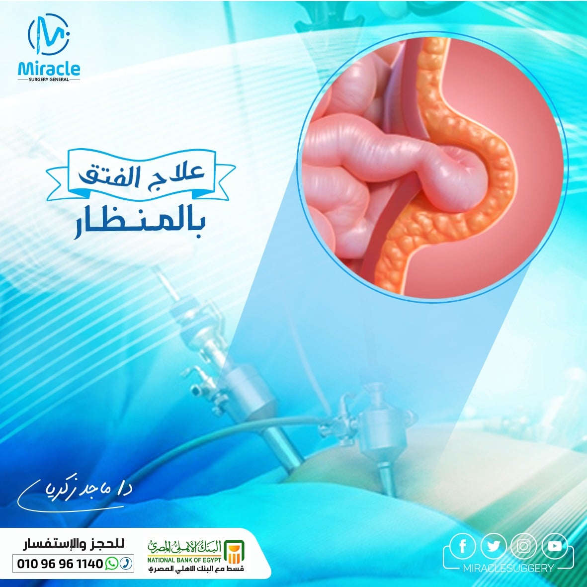 علاج الفتق بالمنظار