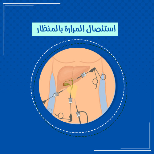 أستئصال المرارة بالمنظار